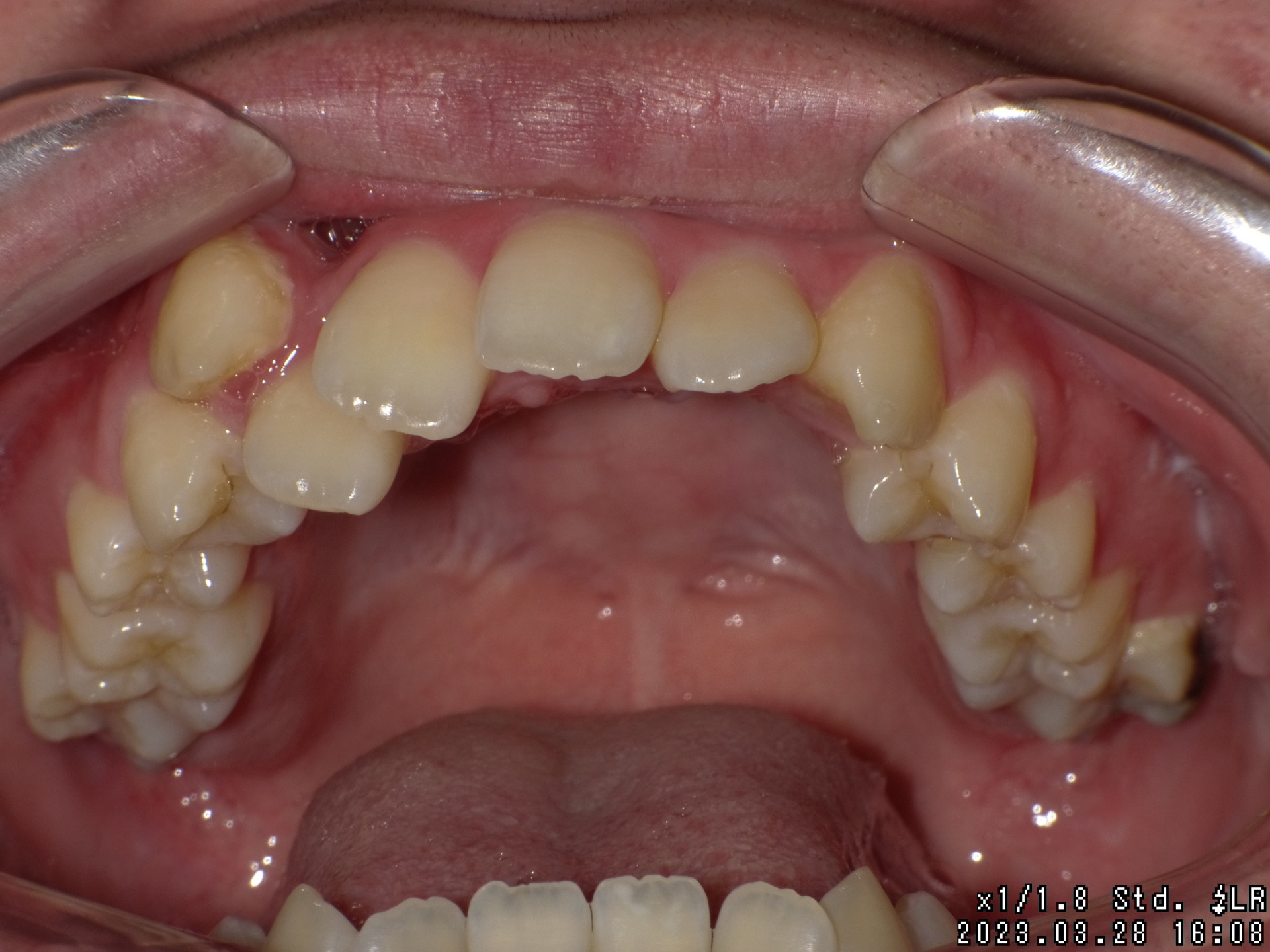 【矯正症例】成人矯正4