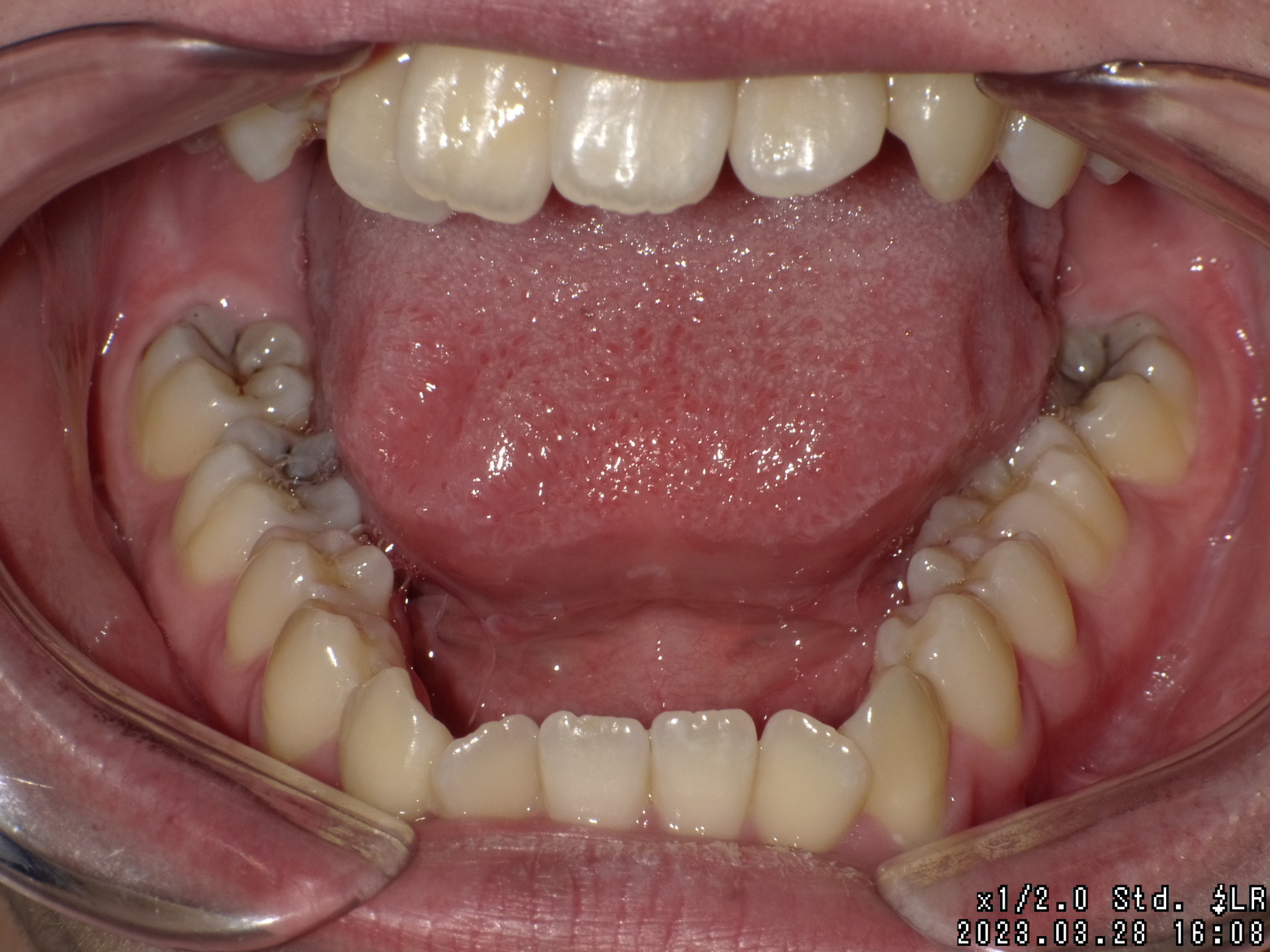 【矯正症例】成人矯正4