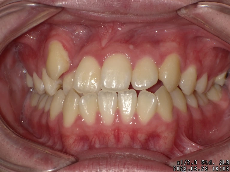 【矯正症例】成人矯正4